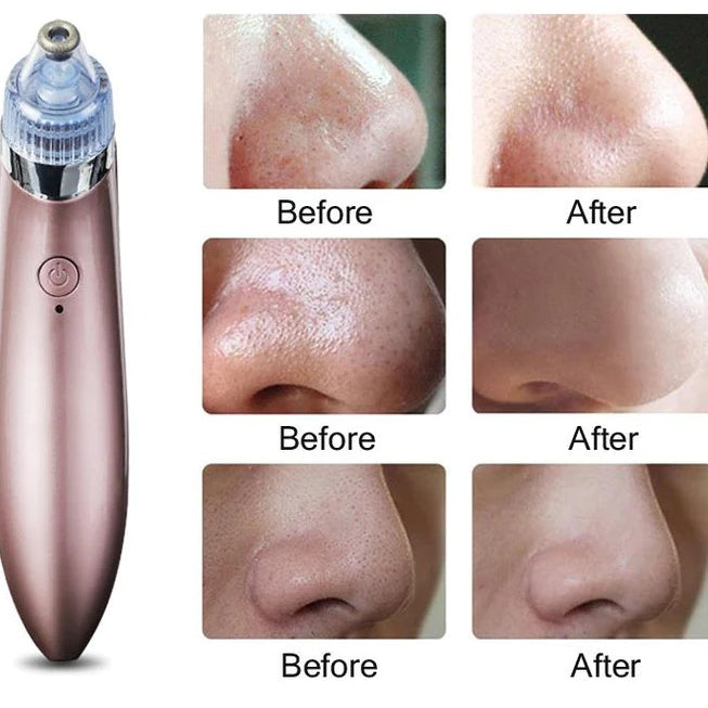 ✨ GlowSkin™ Portable Blackhead Remover ✨